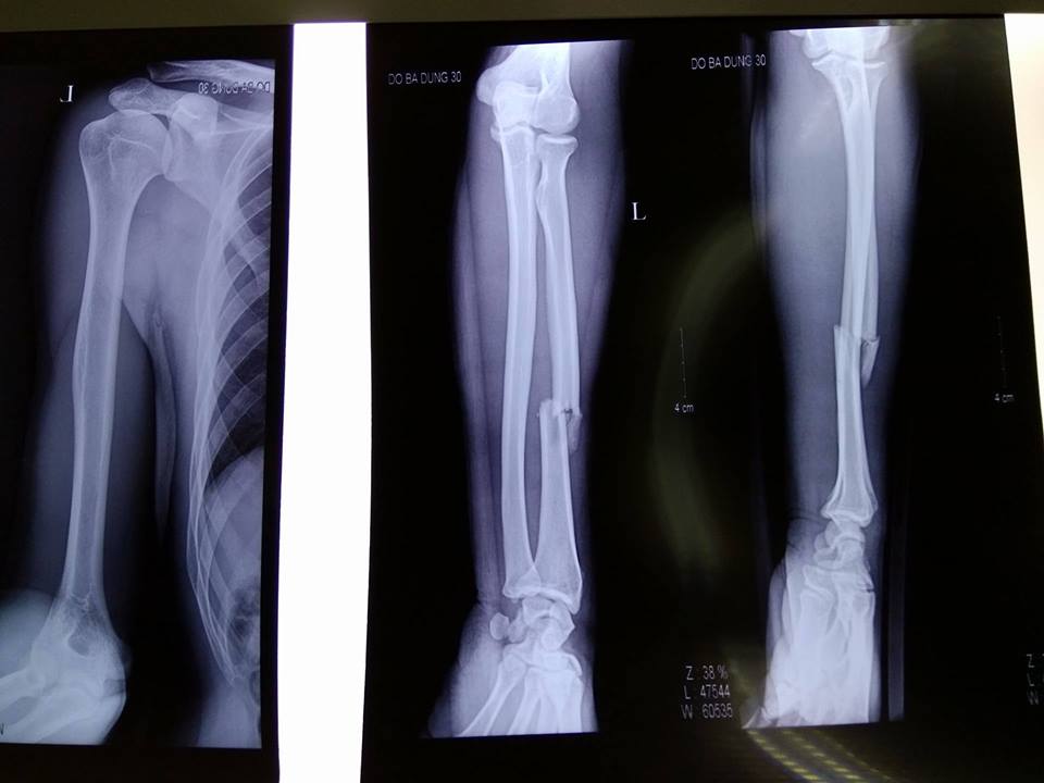 Gãy xương trụ - Hình ảnh minh họa